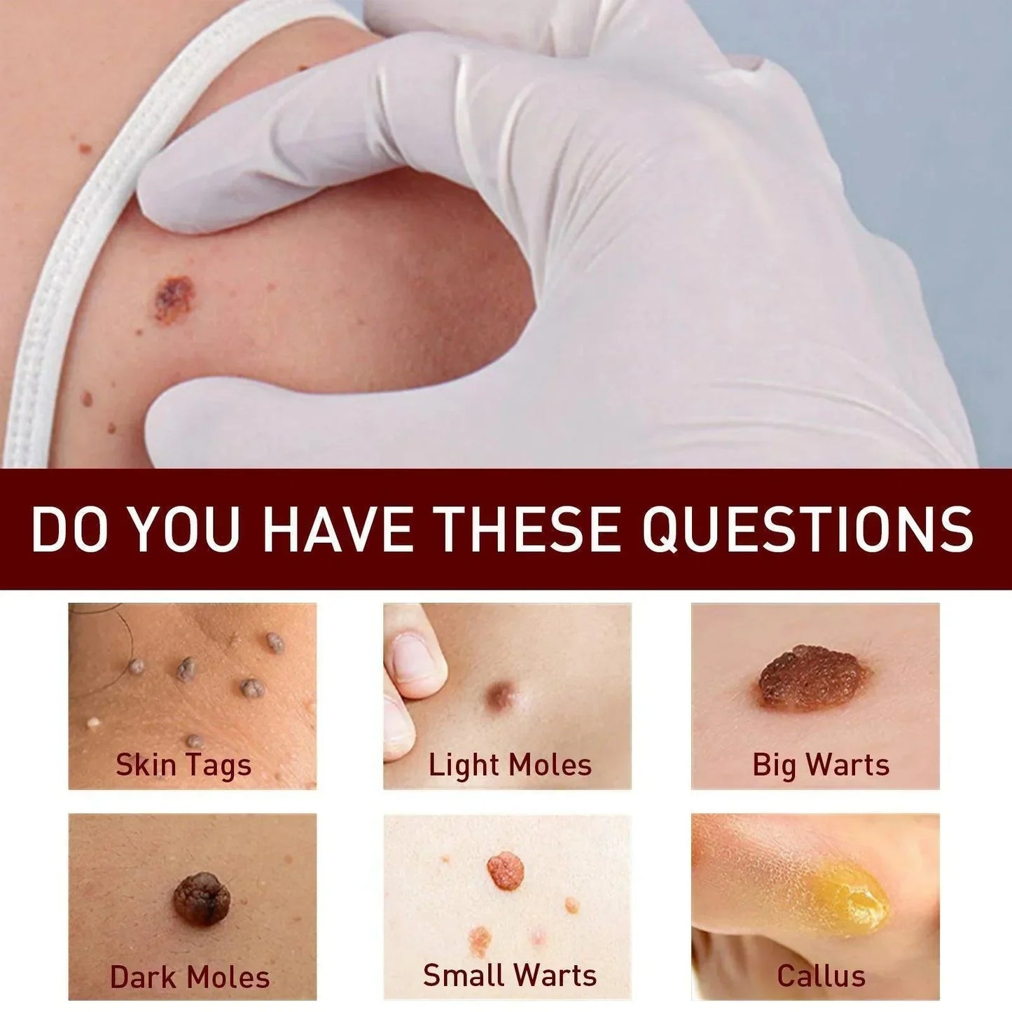 Warts Remover