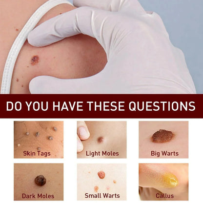 Warts Remover